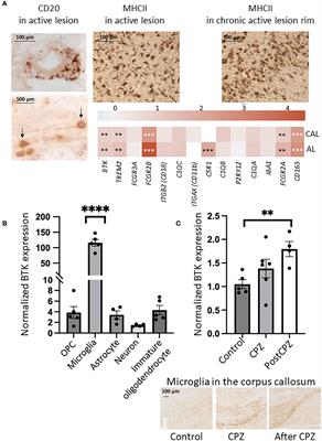 Expression of Bruton´s tyrosine kinase in different type of brain lesions of multiple sclerosis patients and during experimental demyelination